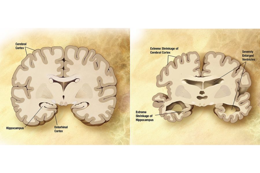 Corte transversal de un cerebro sano y de un cerebro con Alzheimer grave